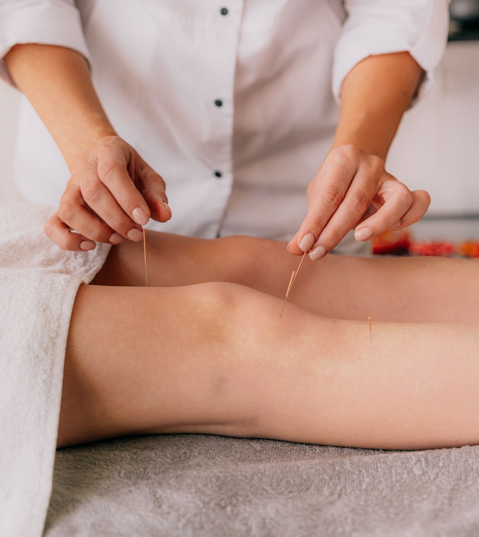 Dry Needling Therapy